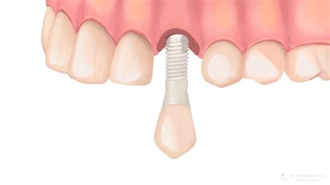 Ceramic implant: advantages, disadvantages and more | Alpine BioDental