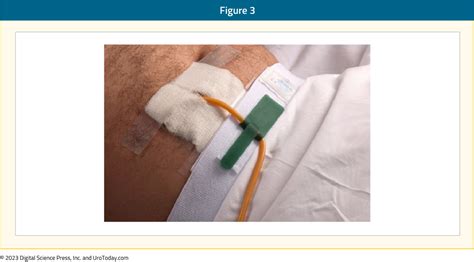 Procedure for Changing a Suprapubic Catheter (SPC or SPT)