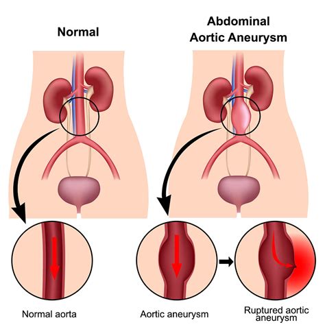 Abdominal aortic aneurysm – Medicine21™