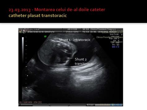 Hidrotorax fetal shunt pleuro amniotic