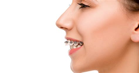 How Do Braces Fix Overbites? - Premier Orthodontics