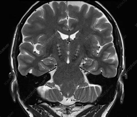 Parkinson's disease, MRI scan - Stock Image - C052/8787 - Science Photo ...