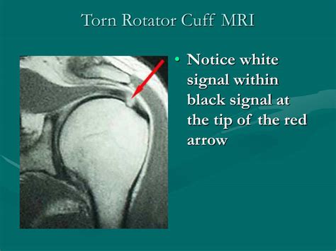 Torn rotator cuff mri image