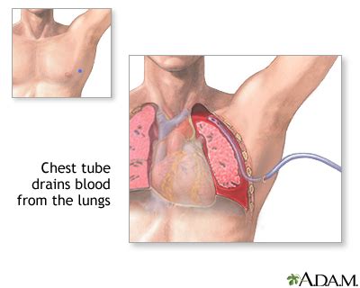 Chest tube insertion - series—Procedure: MedlinePlus Medical Encyclopedia