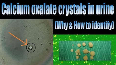 Calcium Oxalate Crystals Kidney Stones