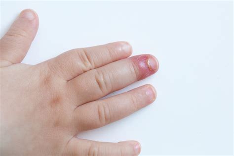 Paronychia - Skin Infection Around the Nails | familydoctor.org