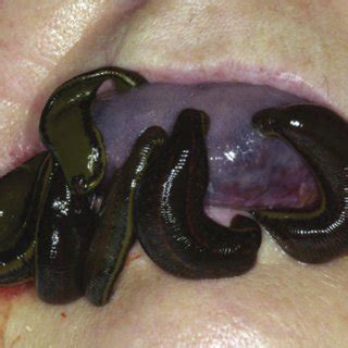 (PDF) Leech got your tongue? haematoma of the tongue treated with ...