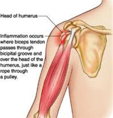 upper arm muscles pain