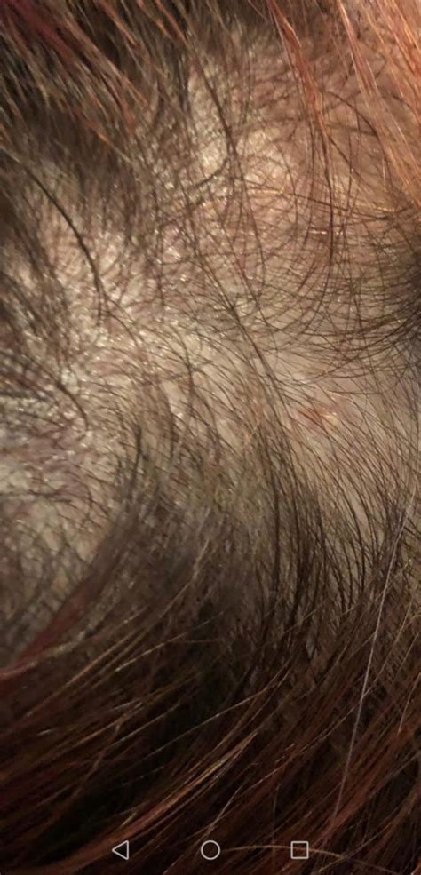 Shingles on scalp or not? | Shingles | Forums | Patient