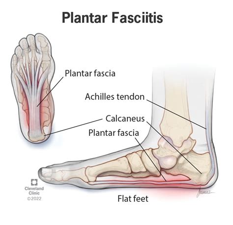 Plantar fasciitis | VeronikaHuriyah