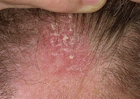 What’s Causing Seborrheic Dermatitis on Scalp? - All Rash