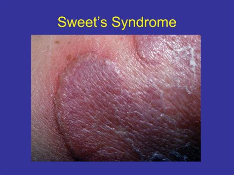 PPT - Sweet’s Syndrome PowerPoint Presentation, free download - ID:6015788