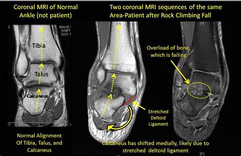 Foot Muscles Mri Anatomy : MRI Ankle Anatomy | Ankle anatomy, Anatomy ...