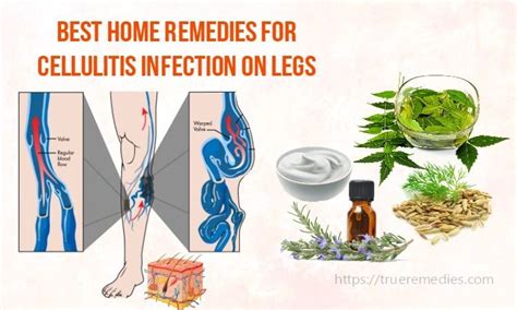 22 Best Home Remedies For Cellulitis Infection On Legs