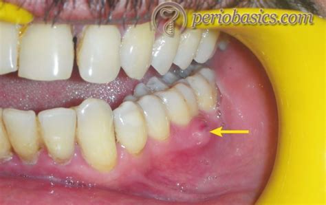 Periodontal Abscess Vs Periapical Abscess