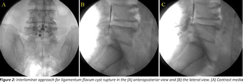 Figure 2 from Percutaneous Ligamentum flavum cyst rupture by ...