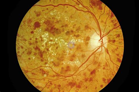 Discontinuing Treatments for Diabetic Retinopathy May Increase ...