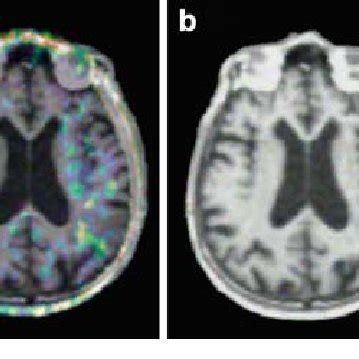 Malignant MCA syndrome. (a) CT brain scan showing signs of early right ...