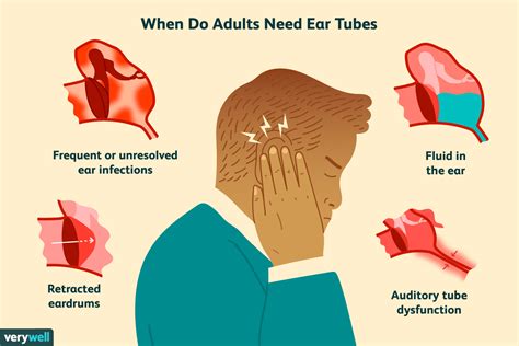 Ear Tubes for Adults: Preparation, Procedure, Recovery