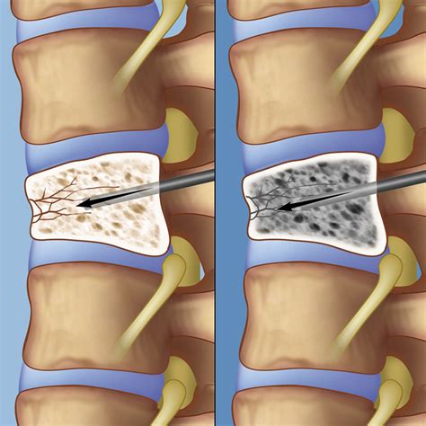 Surgery for Spinal Tumors | Weill Cornell Brain and Spine Center