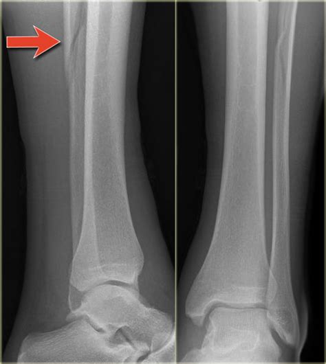 Stress Fracture Fibula X Ray