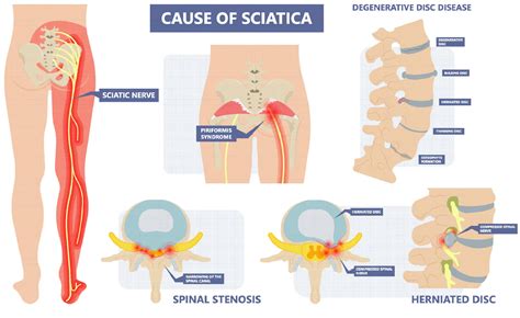 Sciatica : Causes, Symptoms & Treatment at Zandi Chiropractic