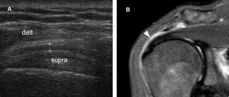 Subdeltoid Bursitis Mri