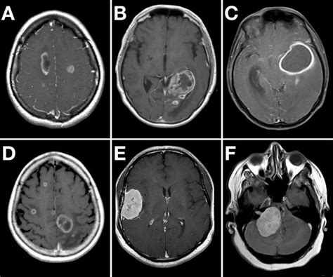 Cat Scan Brain Tumor