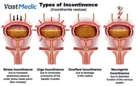 What Is Male Bladder Incontinence? – Vastmedic