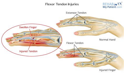 Flexor Tendon Injuries Rehab My Patient - EroFound