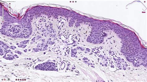 Compound Melanocytic Nevus - Histopathology - YouTube