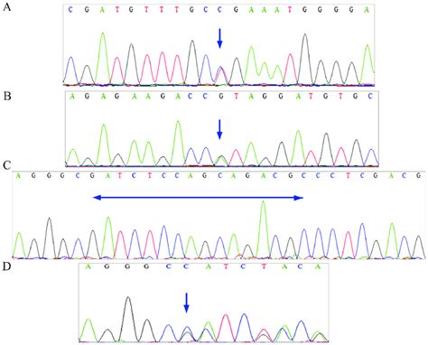 Sequencing peak map for the fibrillin-1 gene with pathogenic mutations ...