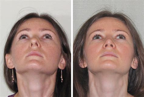 Before and After Nasal Surgery Photos | Dr Garrett Bennett - NY Sinus ...