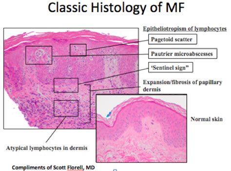 Update in Cutaneous T-cell Lymphoma (CTCL) - Maui Derm