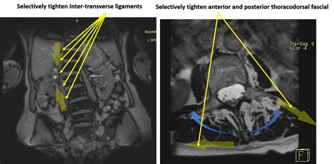 What Is Degenerative Scoliosis? - Regenexx