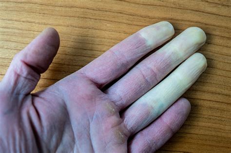 Raynaud's syndrome - the cold truth! - Heale's Clinics