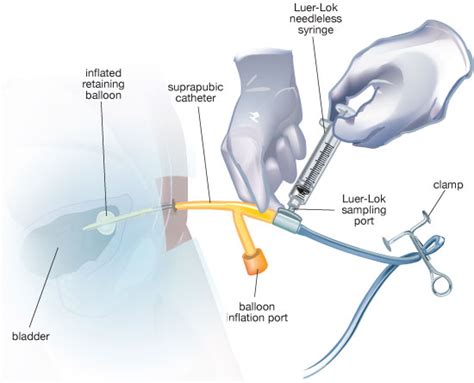 Suprapubic Catheter Diagram