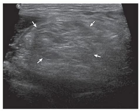 Lipoma: intramuscular. Ultrasound image shows isoechoic intramuscular ...