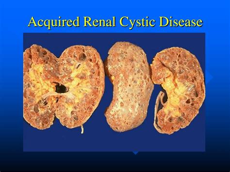 PPT - Renal Cystic Disease PowerPoint Presentation, free download - ID ...