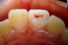 Tooth Trauma | Ask Dr. G