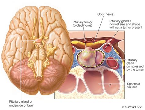 Prolactinoma - Symptoms & causes - Mayo Clinic