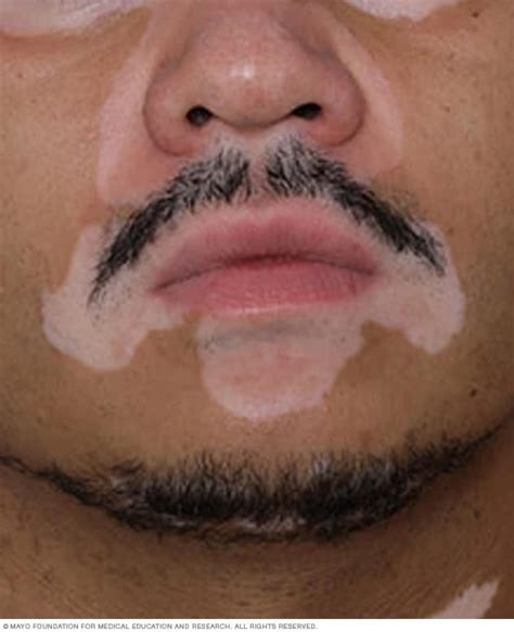 Vitiligo - Symptoms and causes - Mayo Clinic