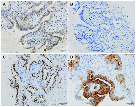 A lung metastasis of a thyroid carcinoma with a micropapillary ...