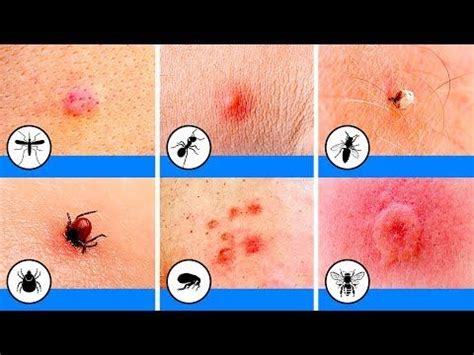 30 HD Pictures Of Oak Mite Bites On Humans - insectza