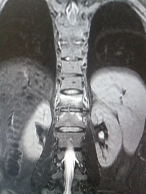 Ankylosing Spondylitis: MRI - Sumer's Radiology Blog