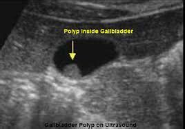 GALL BLADDER STONE-single hole surgery