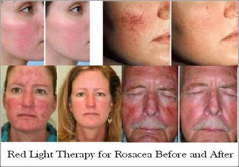 Red Light Therapy-Reduce Wrinkles, Age Spots, Acne, & More! | Red light ...