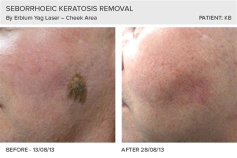 Seborrhoeic Wart Removal Testimonials - Leeds, Bradford, Yorkshire