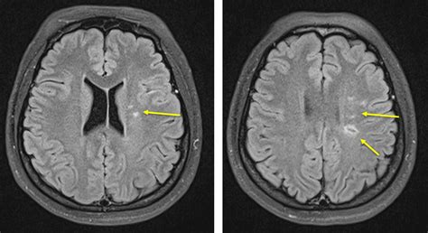 Young stroke with MCA stenosis – Radiology Cases