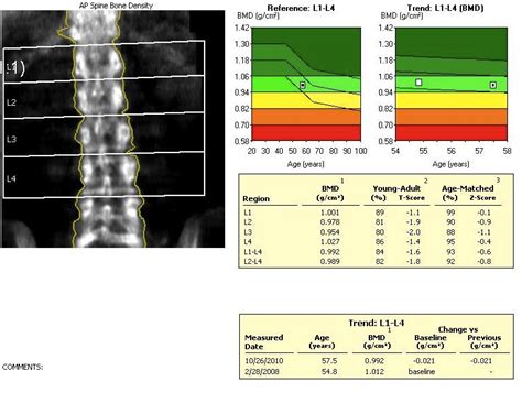 Osteoporosis | The Bone School